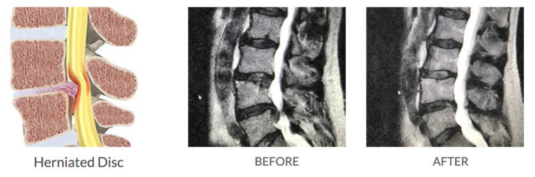 dr-Joshua-Partain-spine-repair-768x255-1