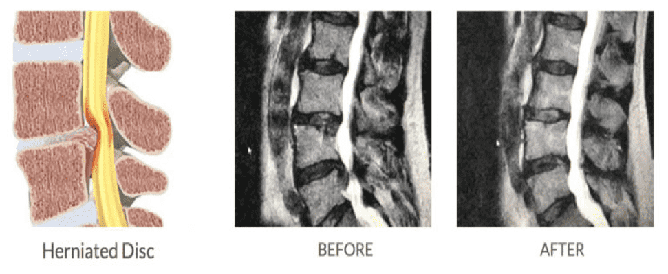 herniations-min