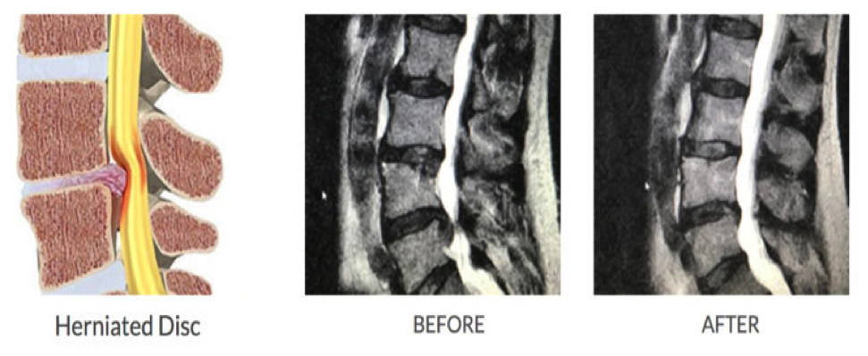 herniations
